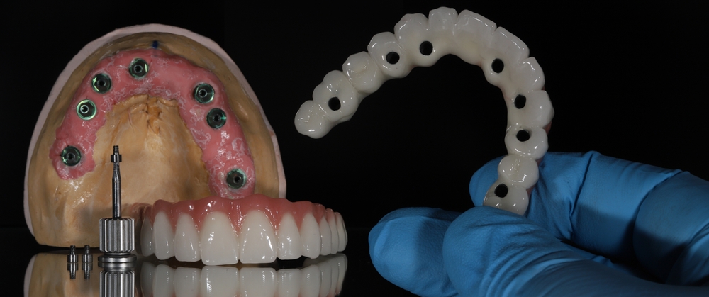 all on 4 dental implants las vegas